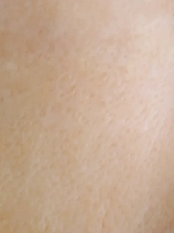cheek, close up after pigmentation treatment