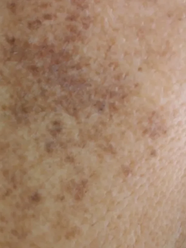 cheek, close up before pigmentation treatment