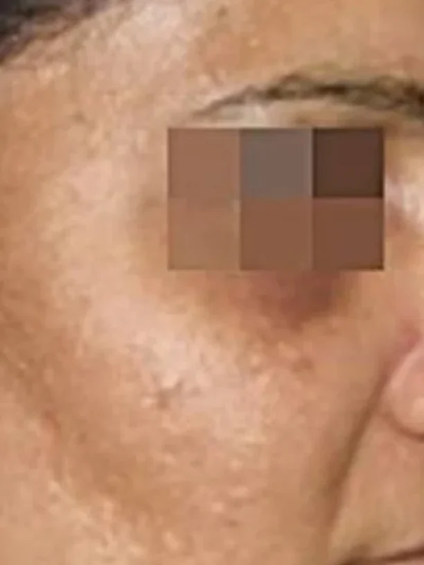 cheek and temple after pigmentation treatment