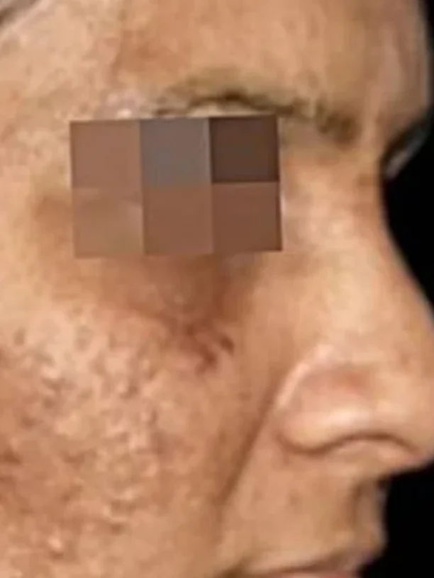 cheek and temple before pigmentation treatment