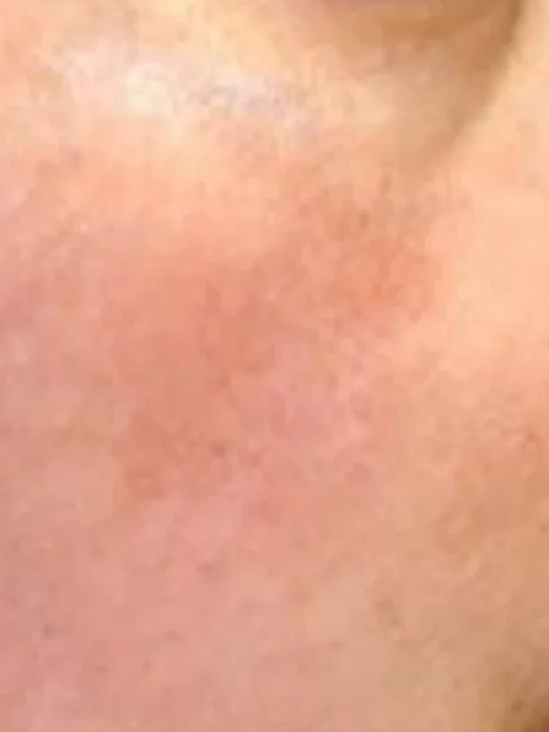 cheek discolouration after pigmentation treatment