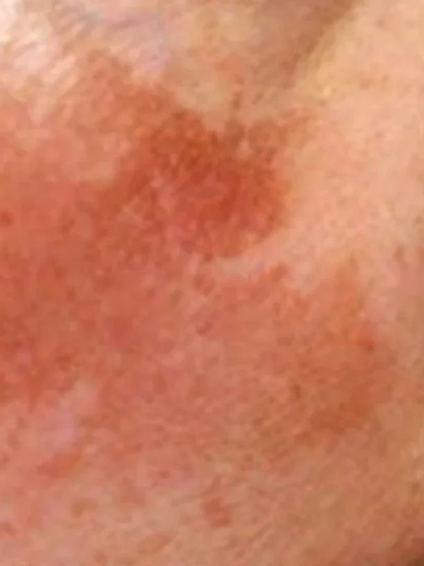 cheek discolouration before pigmentation treatment