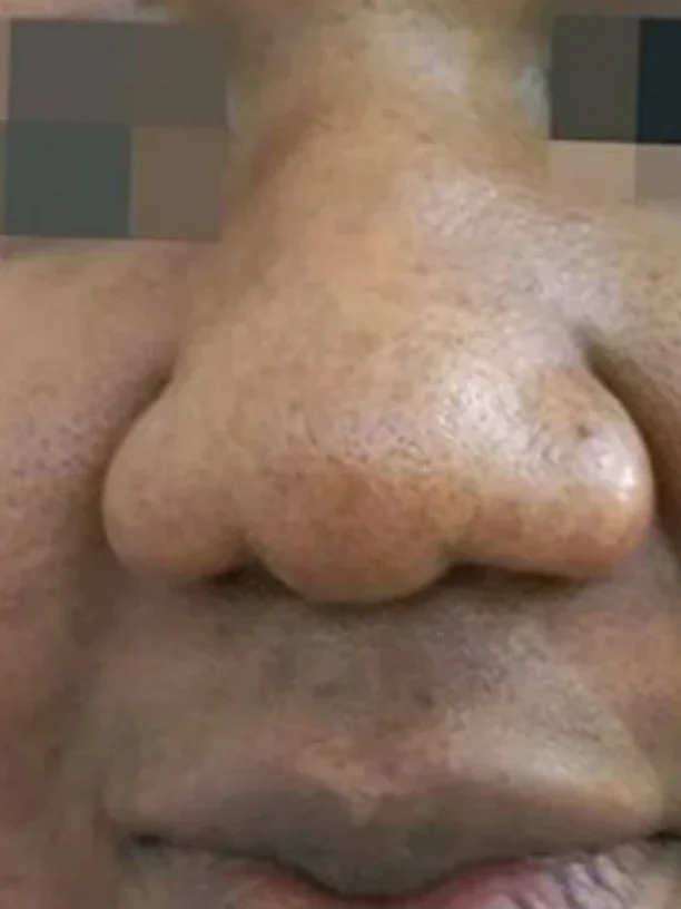 nose and upper lip after pigmentation treatment