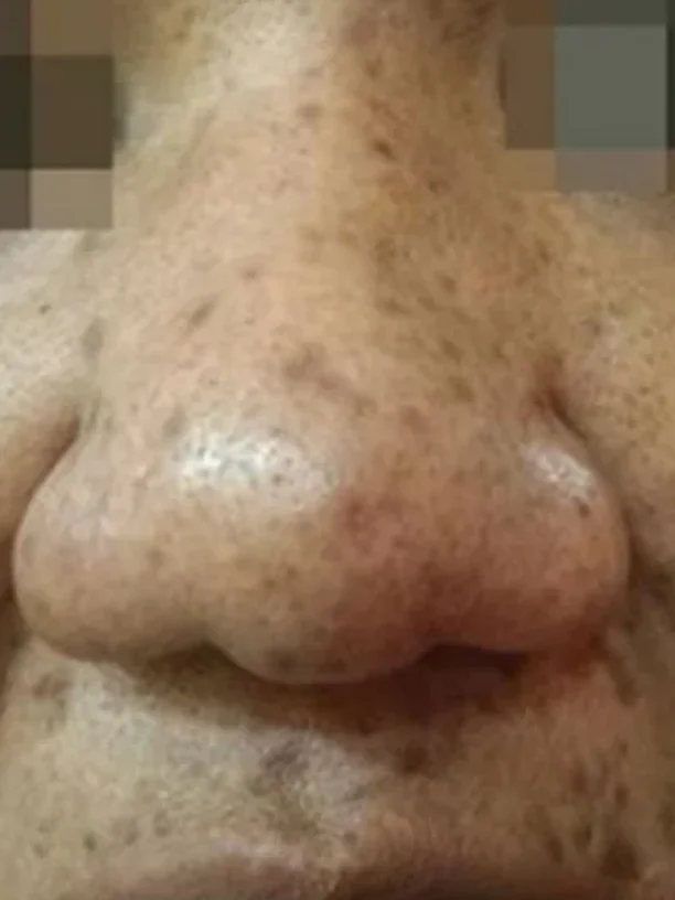 nose and upper lip before pigmentation treatment